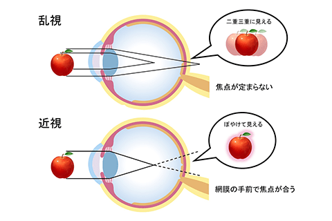 乱視と近視の違い