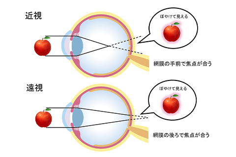 近視と遠視