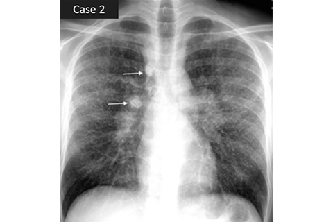 肺サルコイドーシスのイメージ