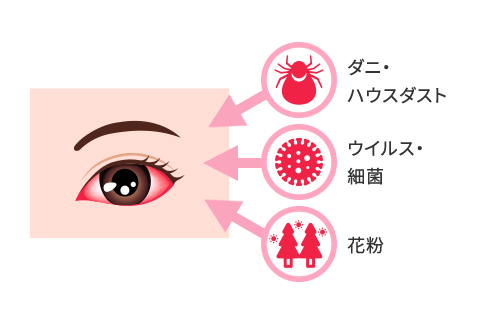 目の充血の原因となるアレルギーイメージ