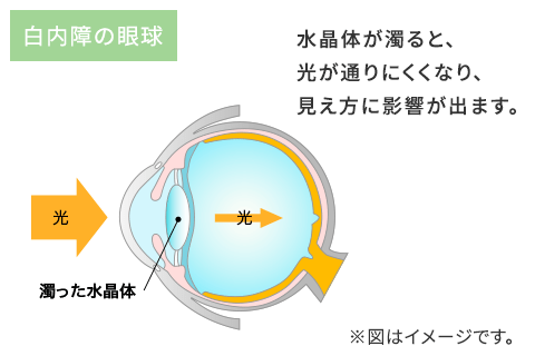 白内障の眼球イメージ