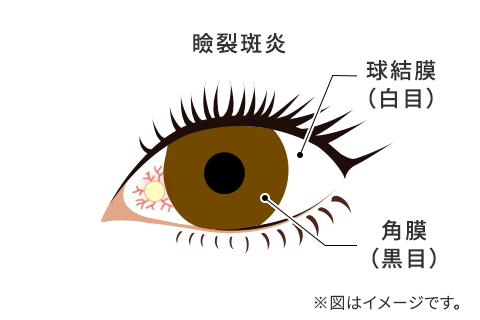 瞼裂斑炎のイメージ図