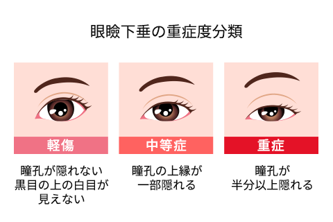 眼瞼下垂の重症度イメージ