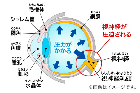 緑内障の発生イメージ図