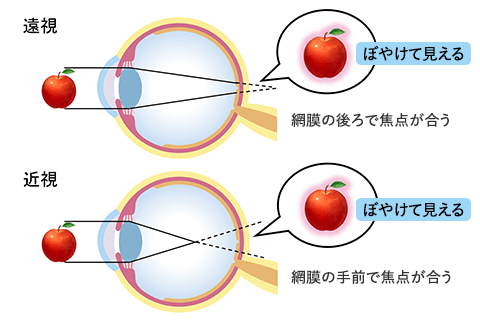 遠視と近視の見え方の仕組み