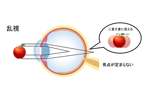 乱視イメージ図