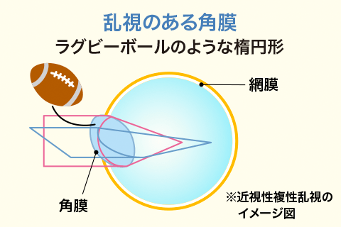 乱視のある角膜のイメージ図