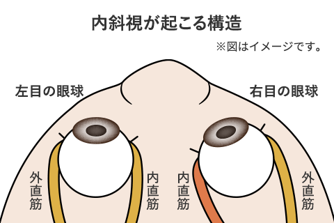 内斜視が起こる構造イメージ図