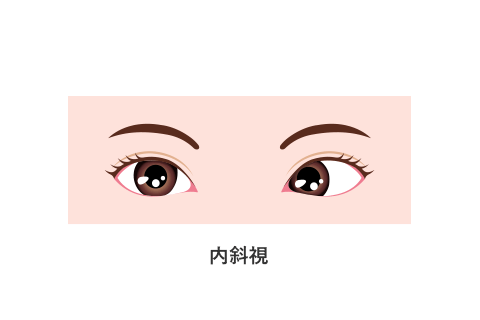 内斜視イメージ