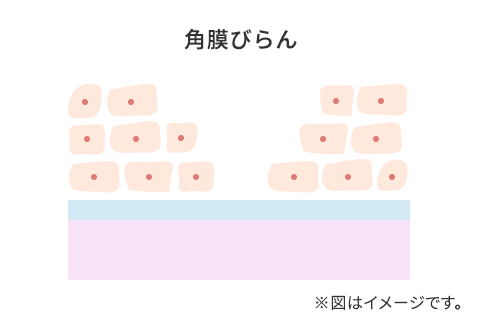 角膜びらんのイメージ