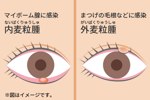 ものもらいのイメージ