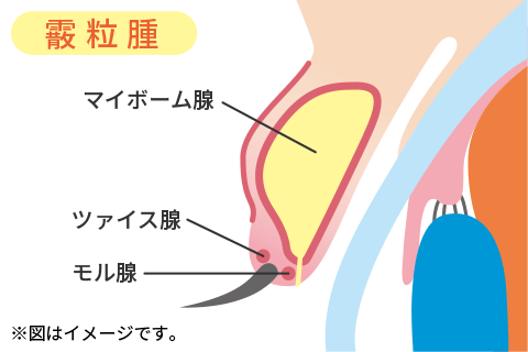 霰粒腫のイメージ