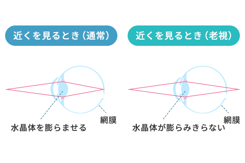 老視により水晶体の硬化のイメージ図