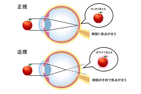 正視と近視の見え方の違いイメージ